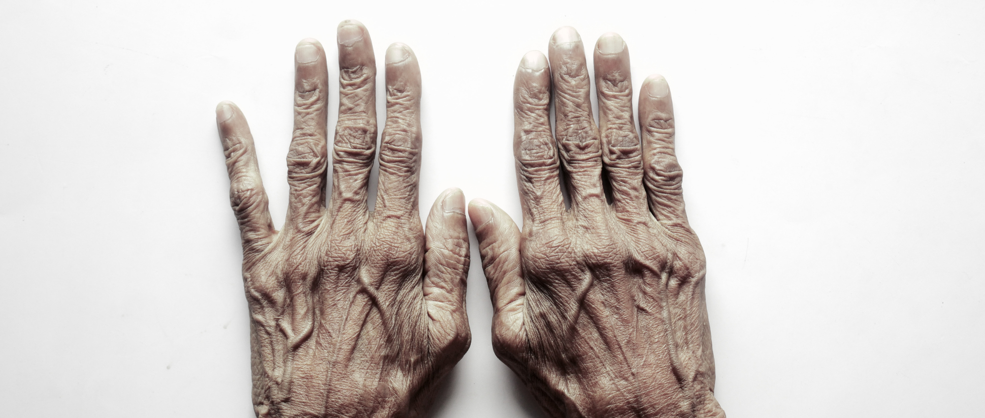 hands trauma